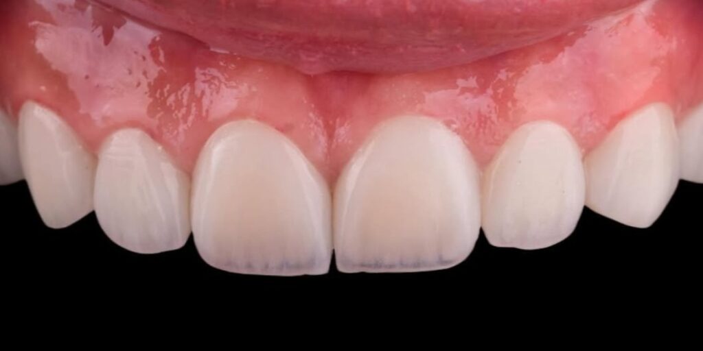 After Smile Club Veneers