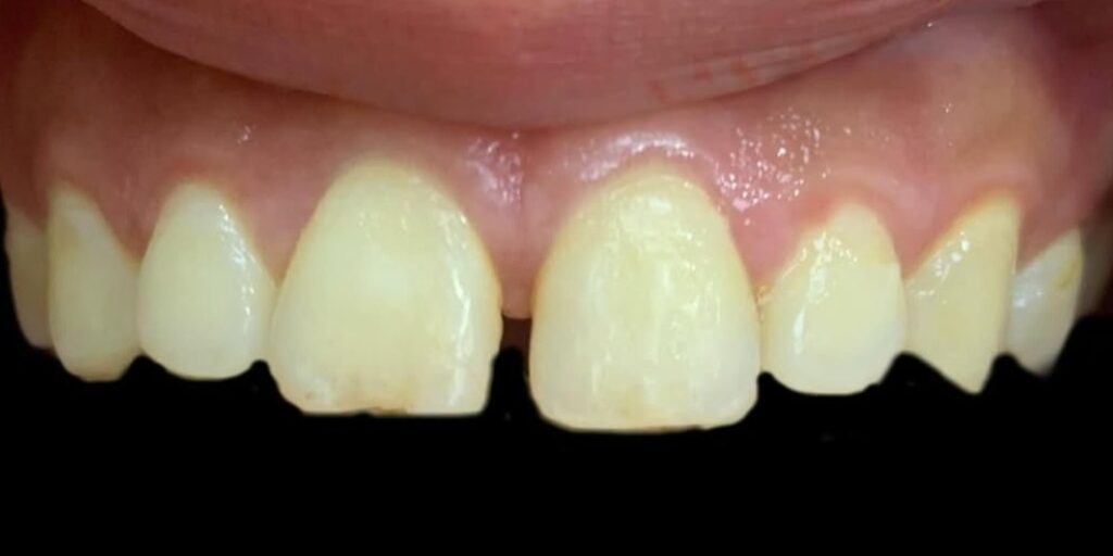 Before Smile Club Veneers