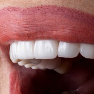 milled stained and glaze veneer - normal veneer