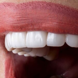 milled stained and glaze veneer - normal veneer